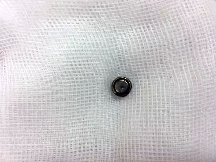 Viên pin được gắp ra từ mũi bé L..