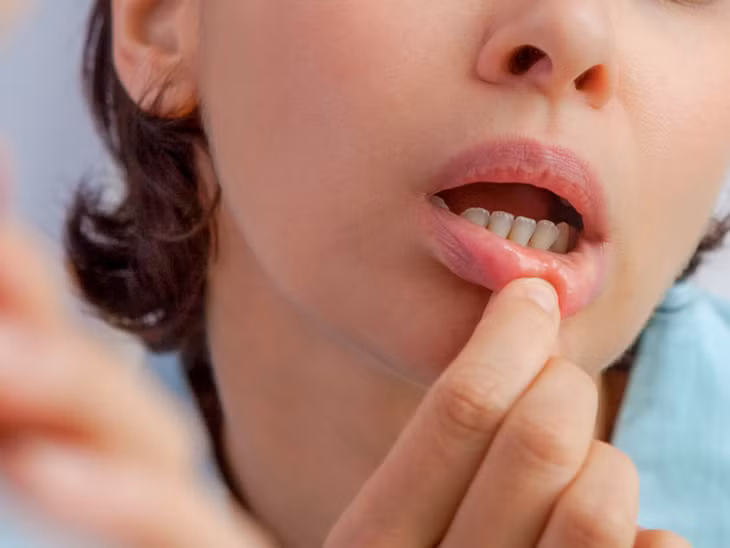 Không nên nặn, bóp, chích các vết loét nhiệt miệng (ảnh minh hoạ)