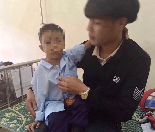 Vụ nổ khiến hai anh em Bảo và Thạch phải nhập viện điều trị. Ảnh: Hoàng Dương