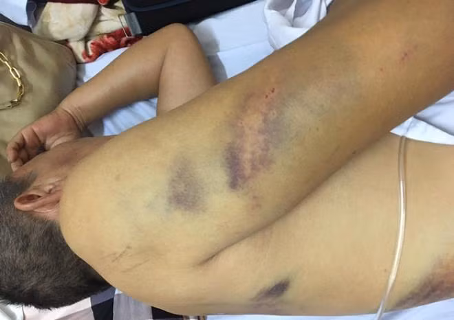 Ông Thập bị gãy xương sườn số 5, 6, 7, 8 bên phải; tràn khí khoang màng phổi bên phải và nhiều vết thương ở phần mềm vừa nhận được kết quả giám định lại, bị tổn hại 20% sức khỏe.