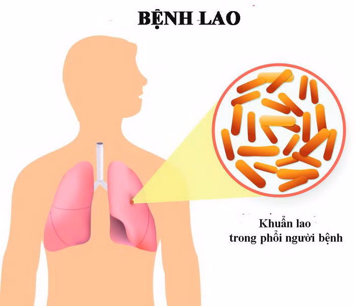Lao phổi tái phát có thể xảy ra khi sức đề kháng suy yếu và thường xuyên tiếp xúc với người nhiễm lao.