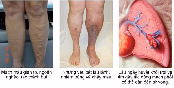 Những dấu hiệu nhận biết viêm tắc động mạch.