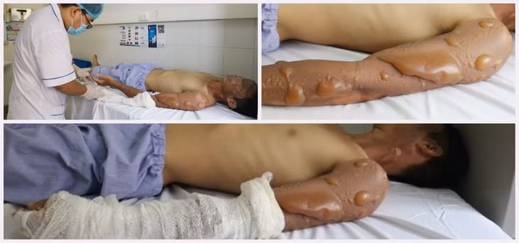 Nam thanh niên bị bỏng. Ảnh do Bệnh viện cung cấp.