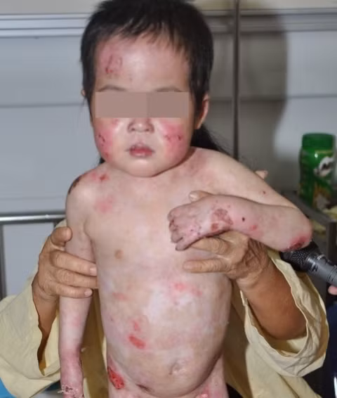 Cháu Việt A. trước khi được điều trị ghép tế bào gốc từ tủy xương.
