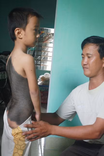 Bé Phong cùng lớp da màu đen đầy lông