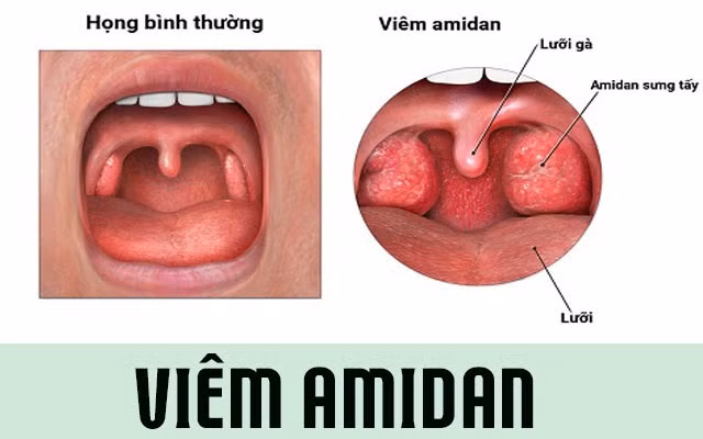viêm amidan tái phát nhiều lần cần cắt bỏ (ảnh minh hoạ theo báo suckhoedoisong.vn)
