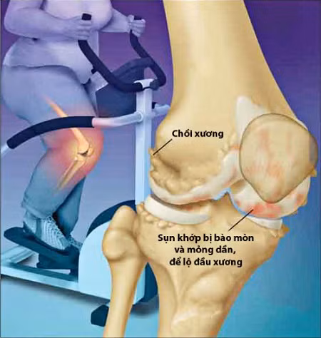 Béo phì gia tăng áp lực lên xương khớp.