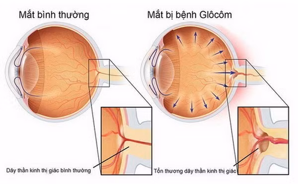 Hình ảnh mắt bị glaucoma.
