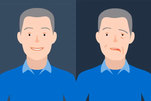 Nụ cười của người khỏe mạnh (trái) và người có nguy cơ bị đột quỵ