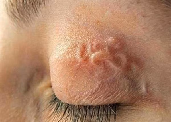  Để có thể xác định chính xác sự có mặt của giun lươn trong cơ thể hay không thì người bệnh cần phải được tiến hành xét nghiệm phân.