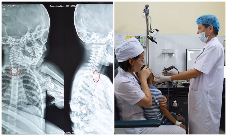 Các bác sĩ lấy dị vật 