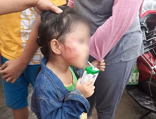 Bé gái bị bảo mẫu đánh. Ảnh: Gia đình cung cấp.