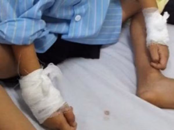 Bệnh nhi bị mổ nhầm tay tại Nghệ An. (Nguồn: VTV)