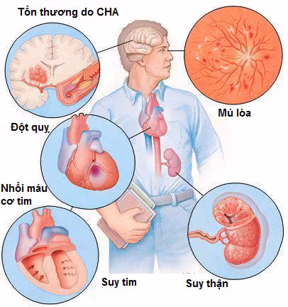 Các tổn thương có thể xảy ra do tăng huyết áp.