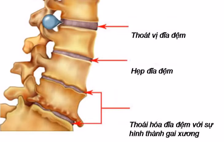 Tình trạng cột sống và tiến trình thoái hóa.