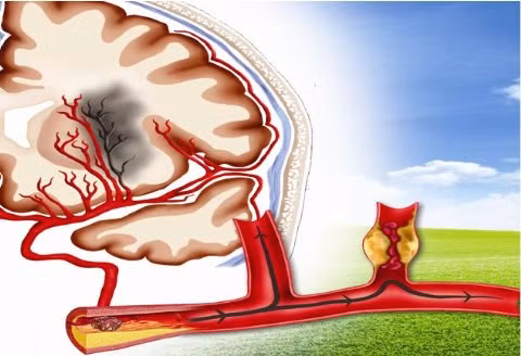 Cholesterol cao có thể gây xơ vữa động mạch não - nguy cơ dẫn đến đột quy.