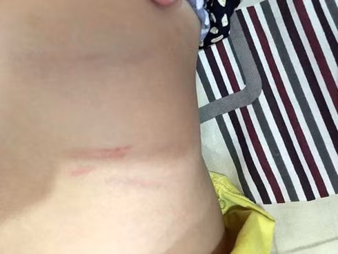 Vết bầm xước trên người cháu bé được xác định do cô giáo đánh. (Ảnh: Pháp Luật TP.HCM)