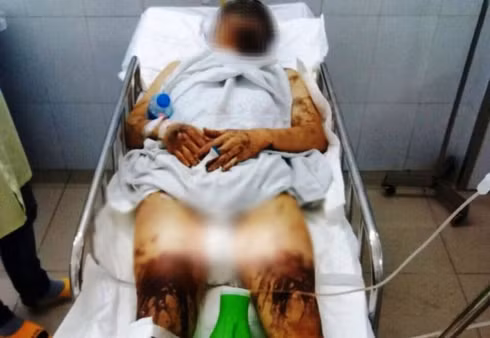 Toàn thân anh Nghiêm bị bỏng nặng. Ảnh: G.Bảo