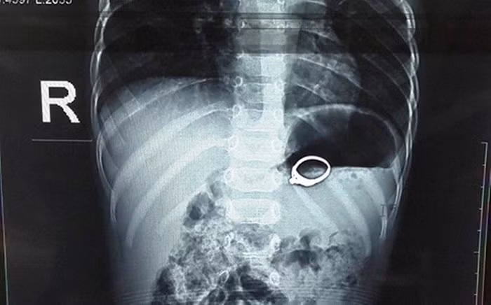 Trong lúc chơi đùa, bé Đ. đã ngậm chiếc nhẫn và nuốt nó vào dạ dày. Phát hiện sự việc, người nhà nhanh chóng đưa cháu bé vào bệnh viện cấp cứu.