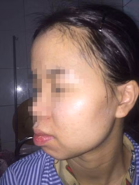 Làn da bệnh nhân sau khi điều trị tại Bệnh viện Da liễu Trung ương đã đẹp trở lại.