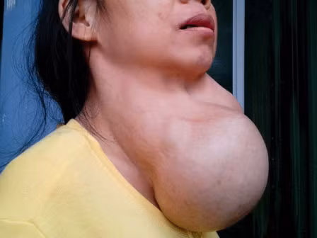 Thiếu hụt iốt - một nguyên nhân dẫn đến bướu cổ.