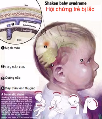 Sơ đồ mô tả tổn thương có thể gặp trong hội chứng trẻ bị lắc.