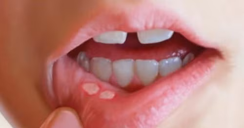 Loét miệng ở trẻ khiến việc nuôi dưỡng và chăm sóc khó khăn.