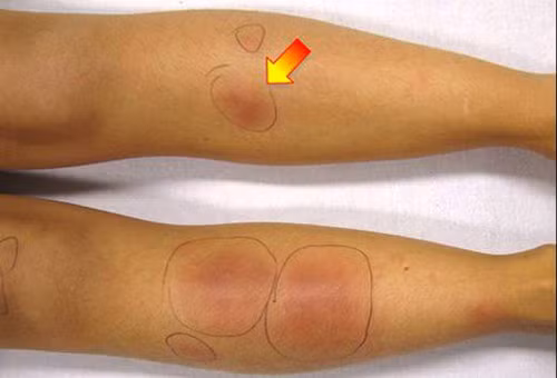 Dấu hiệu của hồng ban nút ở chi dưới.