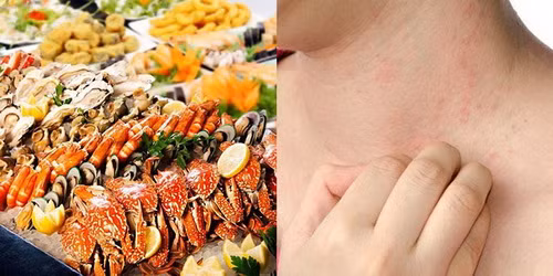 Người có cơ địa dị ứng cần cẩn trọng khi ăn hải sản.