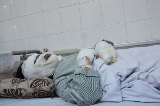 Bệnh nhân bị bỏng toàn bộ khuôn mặt do bóng bay phát nổ được điều trị tại Bệnh viện Xanh Pôn. Ảnh: HQ.