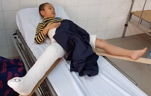 Cháu Trần Chí Kiên bị chấn thương nặng, gãy xương đùi phải nẹp vít xương nhưng nhà trường khẳng định cháu chơi đùa tự ngã. (Ảnh: Vietnamnet)