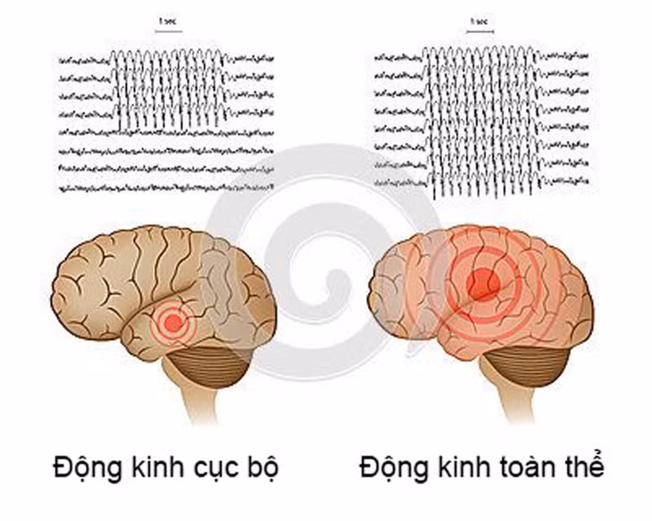 Hình ảnh sóng não đồ của 2 loại động kinh chính là động kinh cục bộ và động kinh toàn thể.