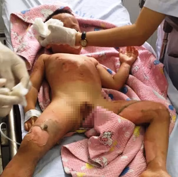 Cháu bé bị bỏng do cồn.