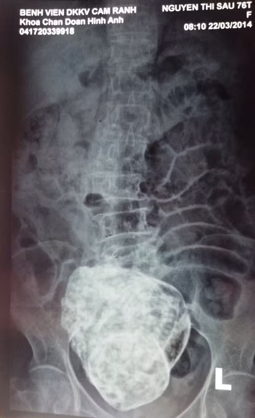 Kết quả chụp phim cho thấy khối thai cứng trong ổ bụng cụ bà. Ảnh: Tường Vi.