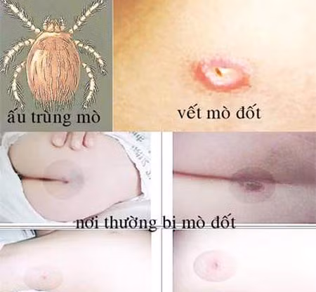 Vết đốt mò thường ở chỗ kín nên dễ bị bỏ qua.
