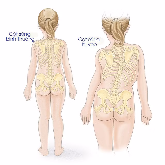 Hình ảnh cột sống bình thường và cột sống bị cong vẹo.