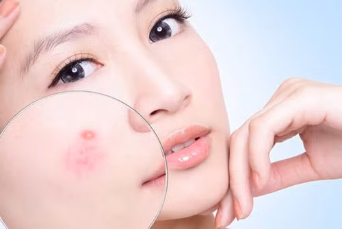 Mụn trứng cá là bệnh thường gặp ở tuổi dậy thì.
