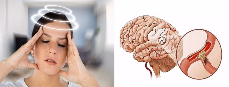 Rối loạn tiền đình. Đồ họa: Hồng Nhật