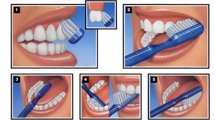 Để phòng sâu răng, cần chải răng đúng cách 3 lần/ngày.