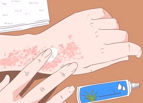 Hãy chuẩn bị sẵn một số loại kem bôi đề phòng trường hợp dị ứng.