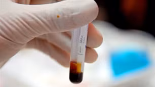 Xét nghiệm HIV đảm bảo an toàn cho bệnh nhân.