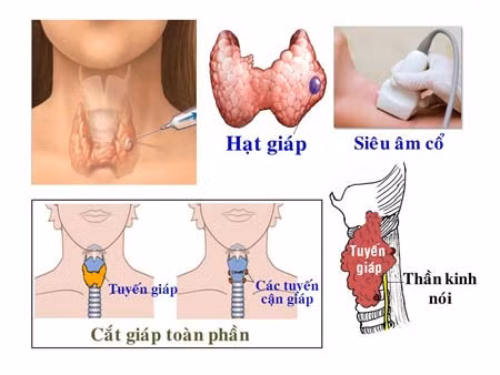 Siêu âm chẩn đoán bướu nhân tuyến giáp.