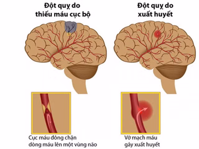 Các loại đột quỵ não.