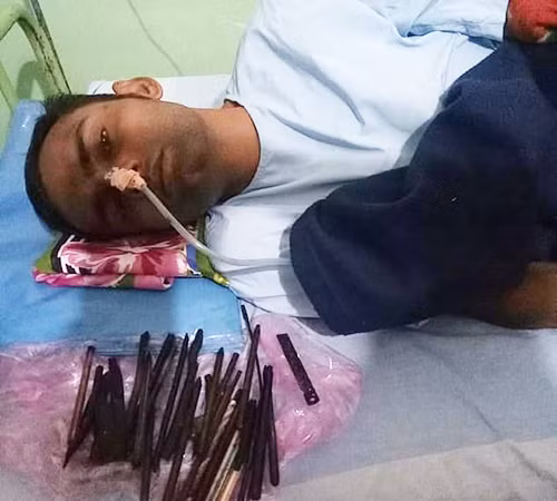 Yogesh Thakur và số vật thể kim loại được các bác sĩ lấy ra từ bụng anh. Ảnh: Newslions