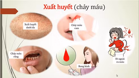 Người bệnh SXH cần theo dõi chặt chẽ tránh biến chứng nguy hiểm. Ảnh minh họa.