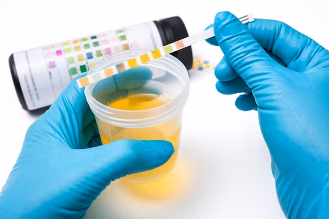 Nước tiểu chứa nhiều loại gene có thể giúp chẩn đoán ung thư tuyến tiền liệt.