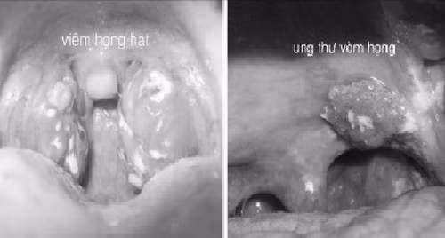 Ung thư vòm họng và viêm họng có những dấu hiệu tương đồng.