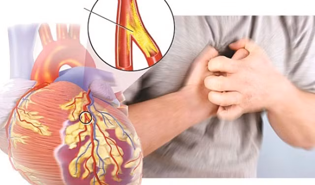 Theo các chuyên gia, bệnh tim mạch rất dễ xảy ra ở người béo phì. Ảnh: TL