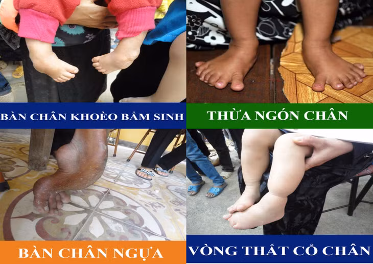 Các dị tật bàn chân