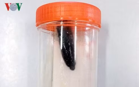 Con đỉa dài 5cm được gắp ra trong đường thở của bé gái.